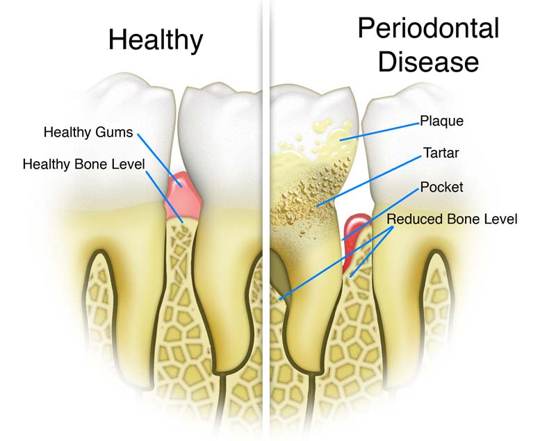Diagram showing the difference between healthy teeth and those affected by Periodontal disease